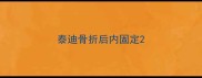 泰迪骨折后内固定